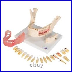 3B Scientific D26 Dental Disease Model Teeth in Jaw Magnified 2 times, 21 parts