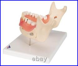 3B Scientific D26 Dental Disease Model Teeth in Jaw Magnified 2 times, 21 parts