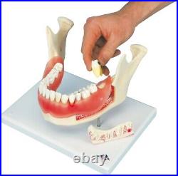 3B Scientific D26 Dental Disease Model Teeth in Jaw Magnified 2 times, 21 parts
