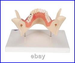 3B Scientific D26 Dental Disease Model Teeth in Jaw Magnified 2 times, 21 parts