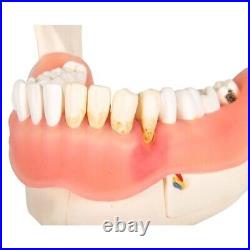 3B Scientific D26 Dental Disease Model Teeth in Jaw Magnified 2 times, 21 parts