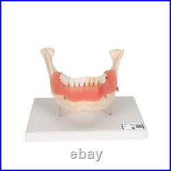 3B Scientific D26 Dental Disease Model Teeth in Jaw Magnified 2 times, 21 parts