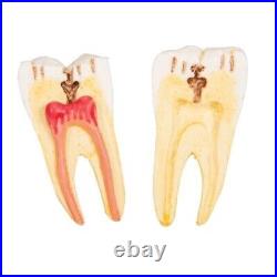 3B Scientific D26 Dental Disease Model Teeth in Jaw Magnified 2 times, 21 parts