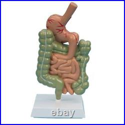 Model Diseased Digestive System Stomach Anatomy Intestine Colon Anatomical Parts